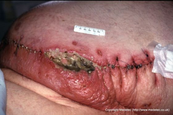 surgical wound infection