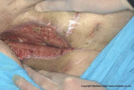 Wound Dressing Selection: Types and Usage - WoundSource