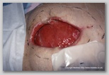 Abdominal wound