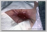 Abdominal wound