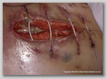 Abdominal wound