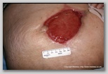 Abdominal wound