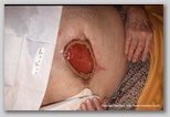 Abdominal wound