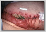 Abdominal wound