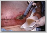 Abdominal wound