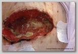 Abdominal wound