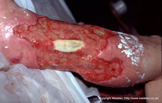 leg ulcer