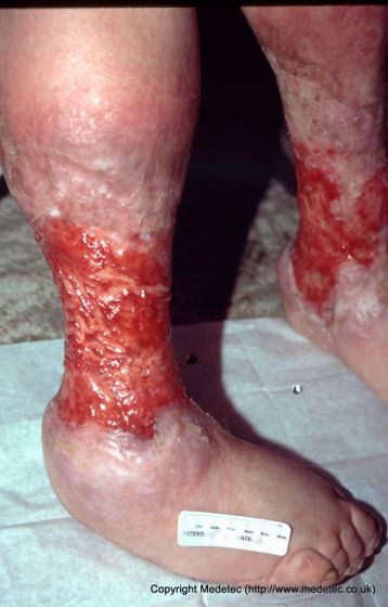 leg ulcer