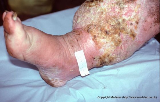 leg ulcer