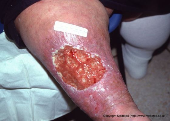 # Diabetic Leg Ulcer - 3 Symptoms Of Diabetes