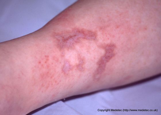 Leg ulcers : Causes , symptoms, treatment, prevention