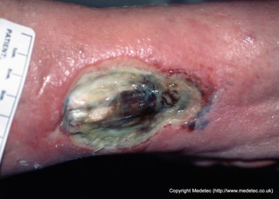 infected surgical wound #10