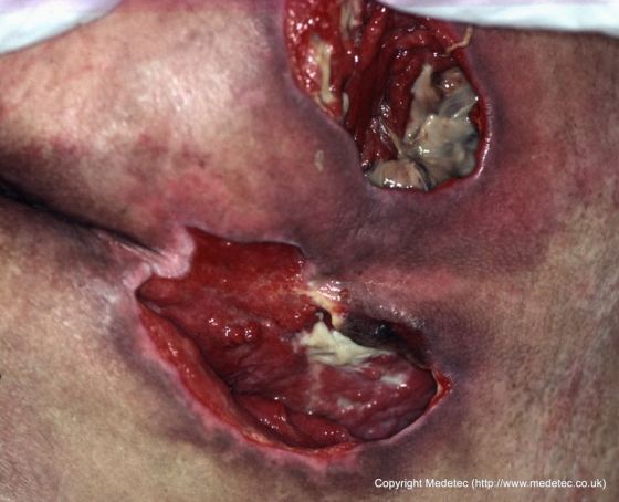 infected surgical wound #11
